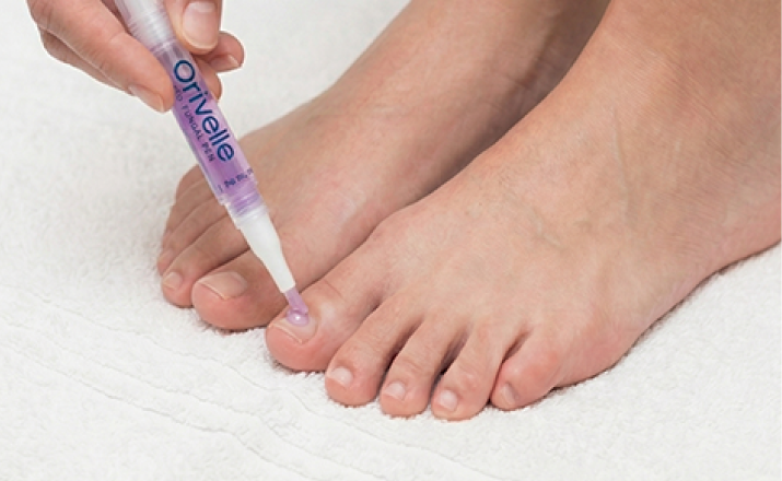 Applying Orivelle pen to a toenail